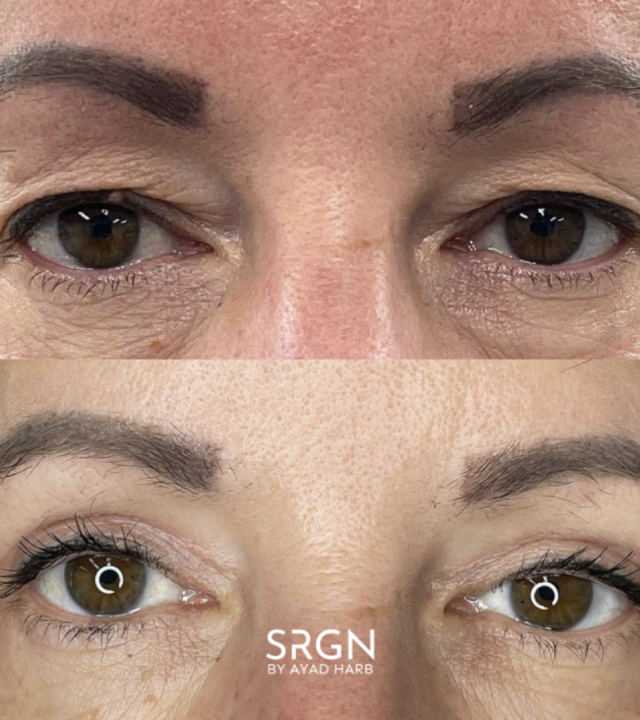 blepharoplasty treatment results
